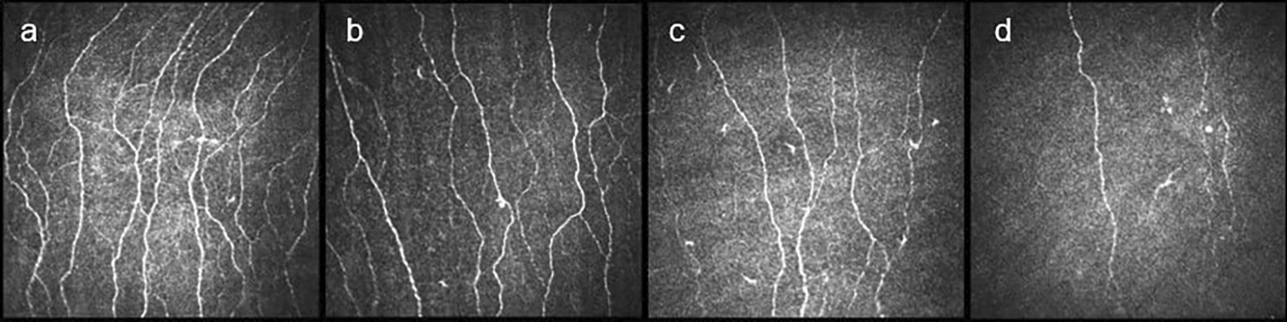 Diabetic corneal neuropathy and its relation to the severity of retinopathy in patients with type 2 diabetes mellitus: an in vivo confocal microscopy study