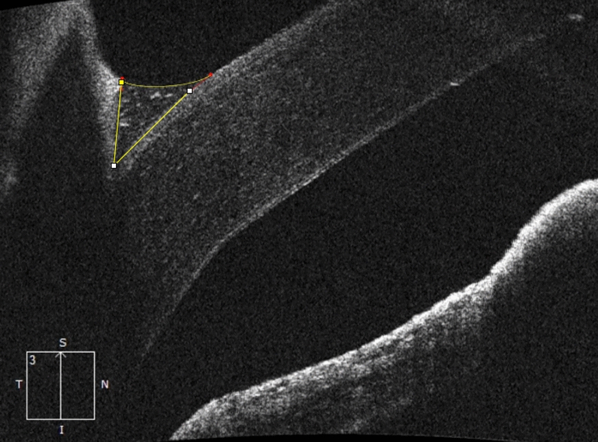 Evaluation of the relationship between tear meniscus changes and quality of life outcomes after external dacryocystorhinostomy