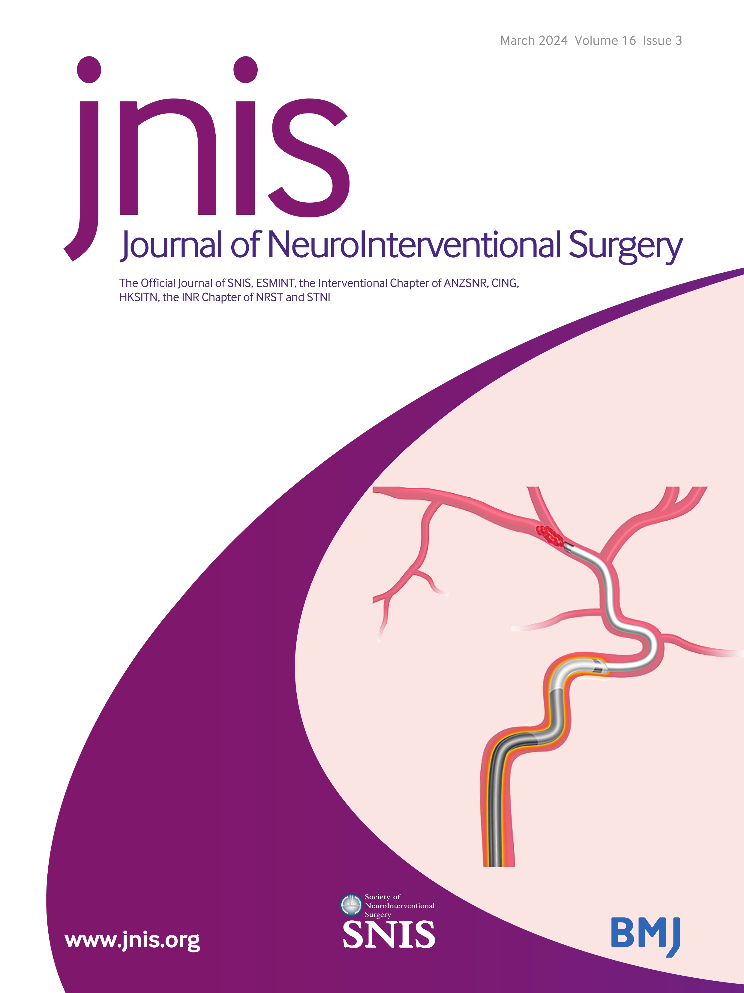 Double microcatheter reduction using partially deployed Atlas stents in treating a large dysplastic MCA bifurcation aneurysm with Y stent assisted coiling
