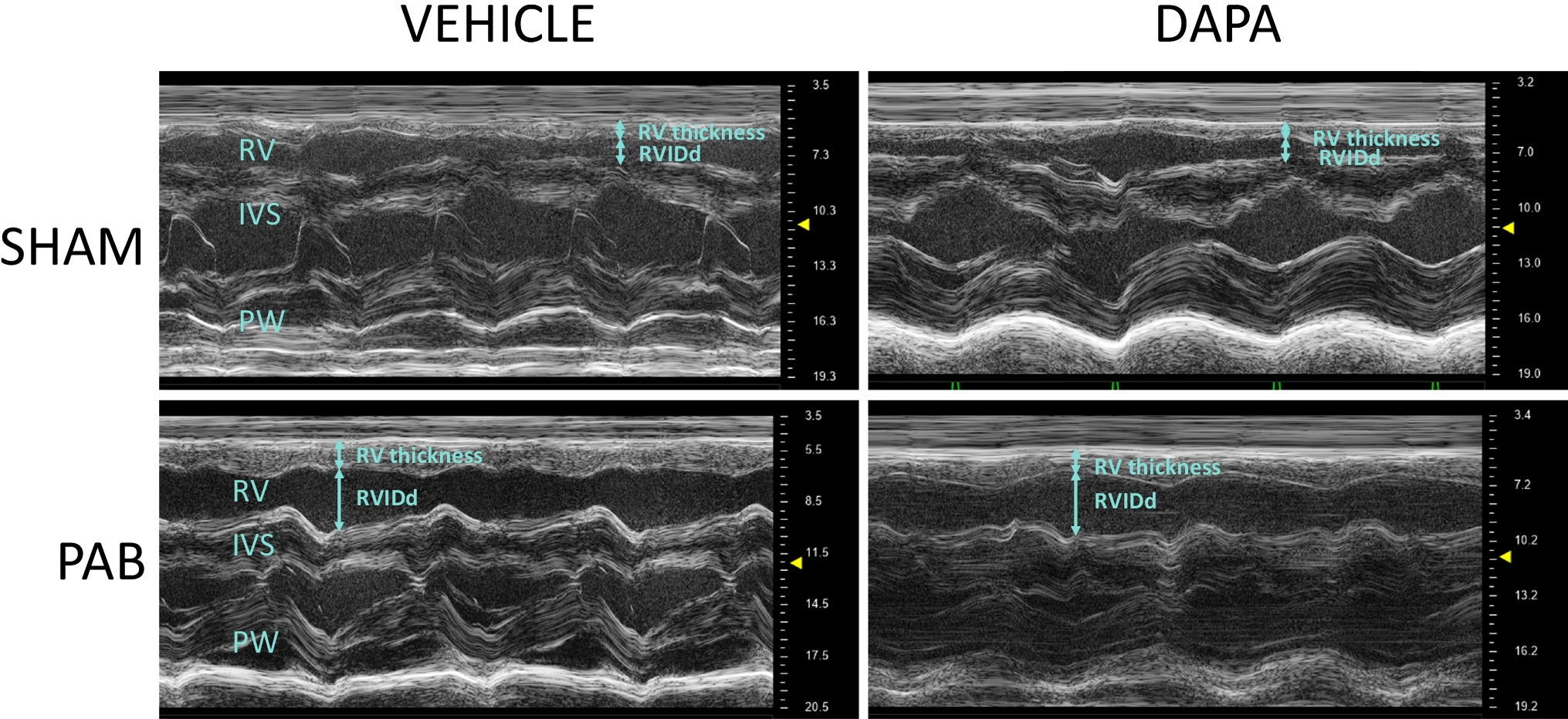 The SGLT2i Dapagliflozin Reduces RV Mass Independent of Changes in RV Pressure Induced by Pulmonary Artery Banding