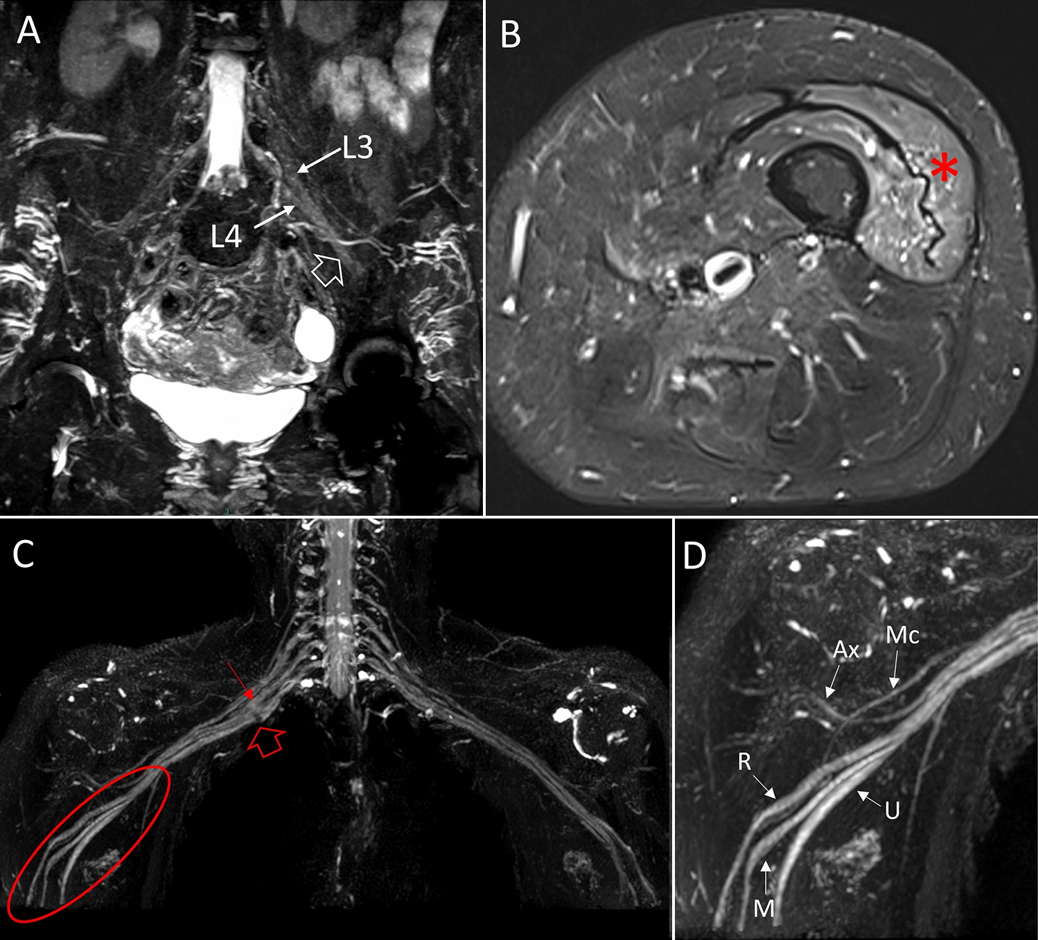 Multifocal recurrent neuralgic amyotrophy in an immunocompromised patient