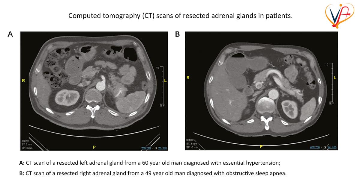 Clinical Features and Etiology of Recurrent Hypertension after Adrenalectomy