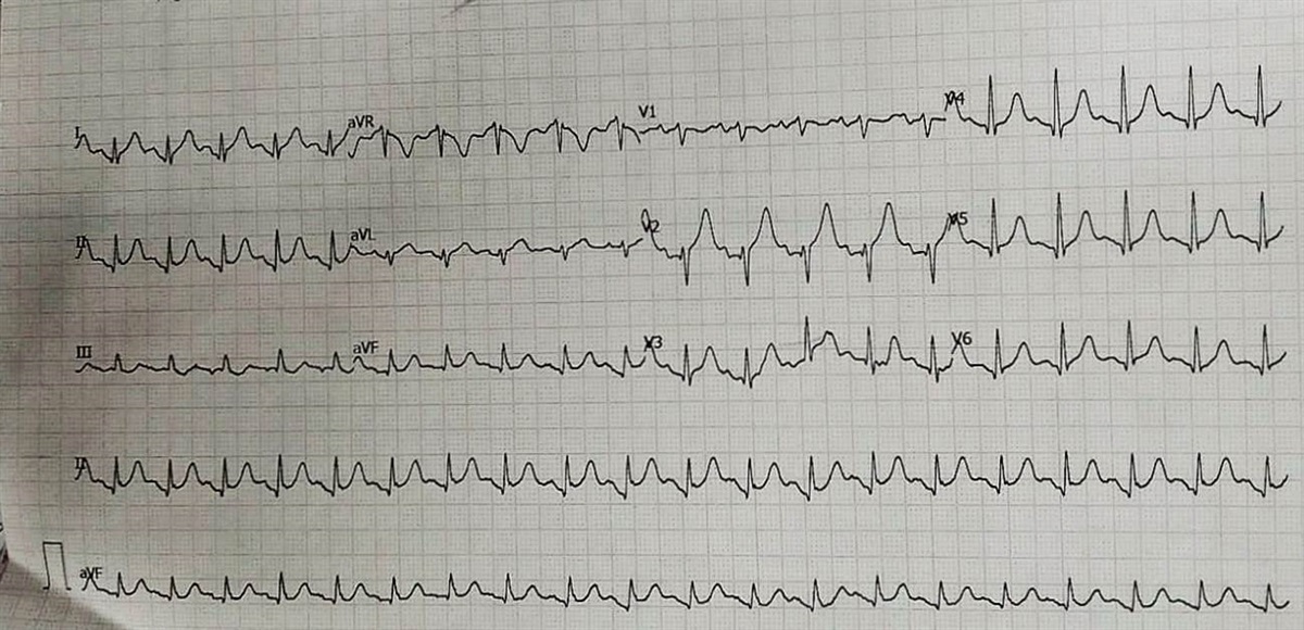 Unexpected case of Graves` disease induced myocarditis: a case report