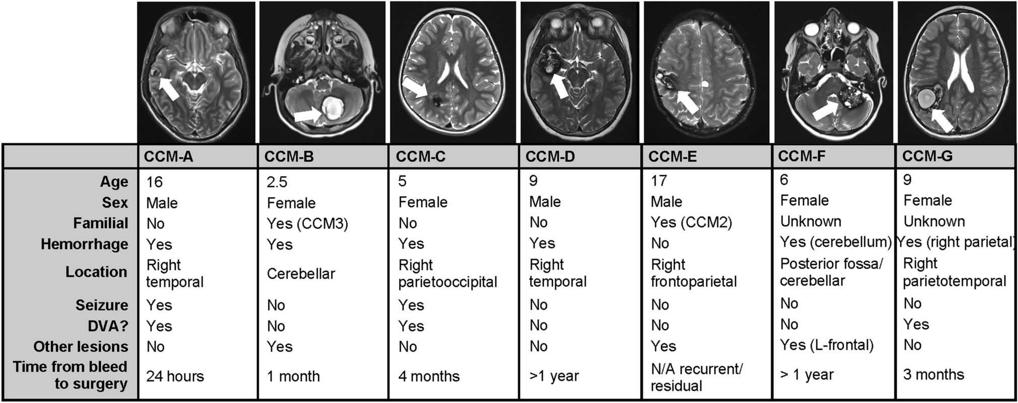 Discovery and Characterization of Ephrin B2 and EphB4 Dysregulation and Novel Mutations in Cerebral Cavernous Malformations: In Vitro and Patient-Derived Evidence of Ephrin-Mediated Endothelial Cell Pathophysiology