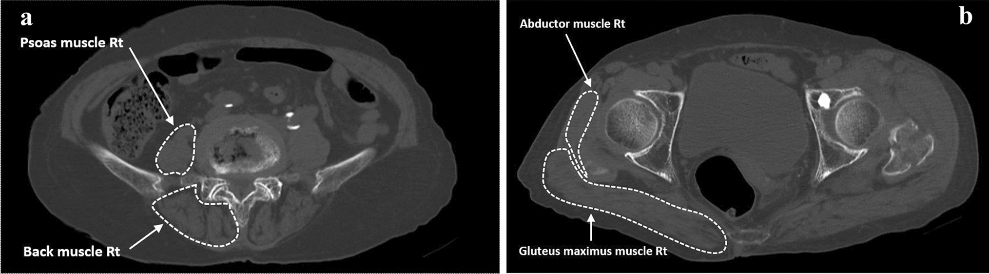 Psoas muscle area is associated with prognosis in elderly patients with hip fracture