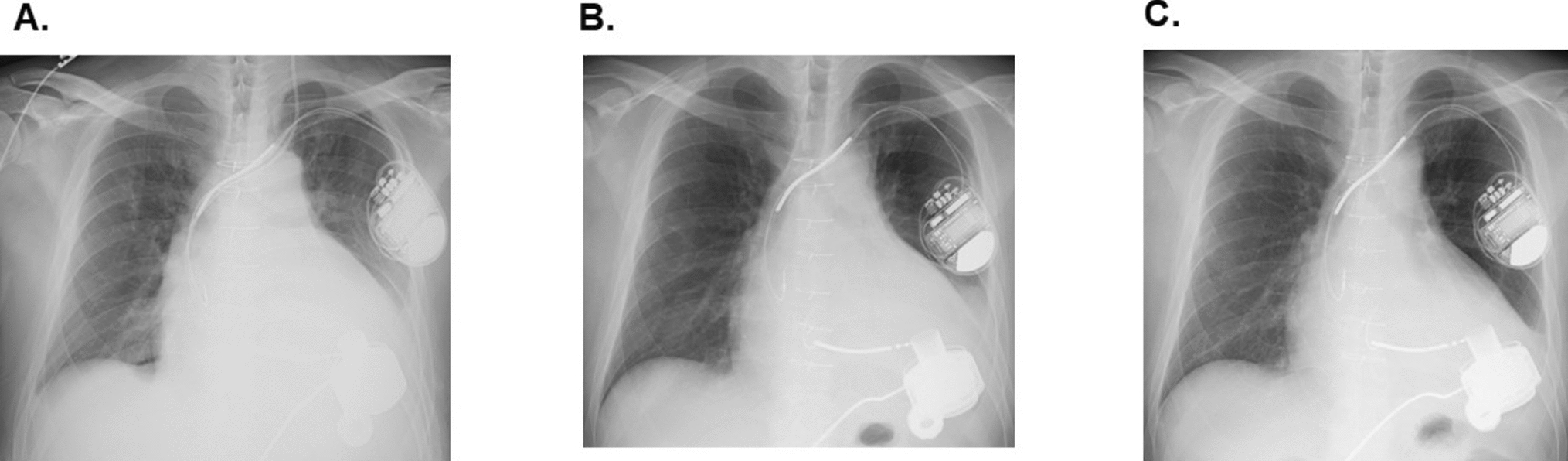 Successful management of HeartMate 3 in a patient with arrhythmogenic right ventricular cardiomyopathy