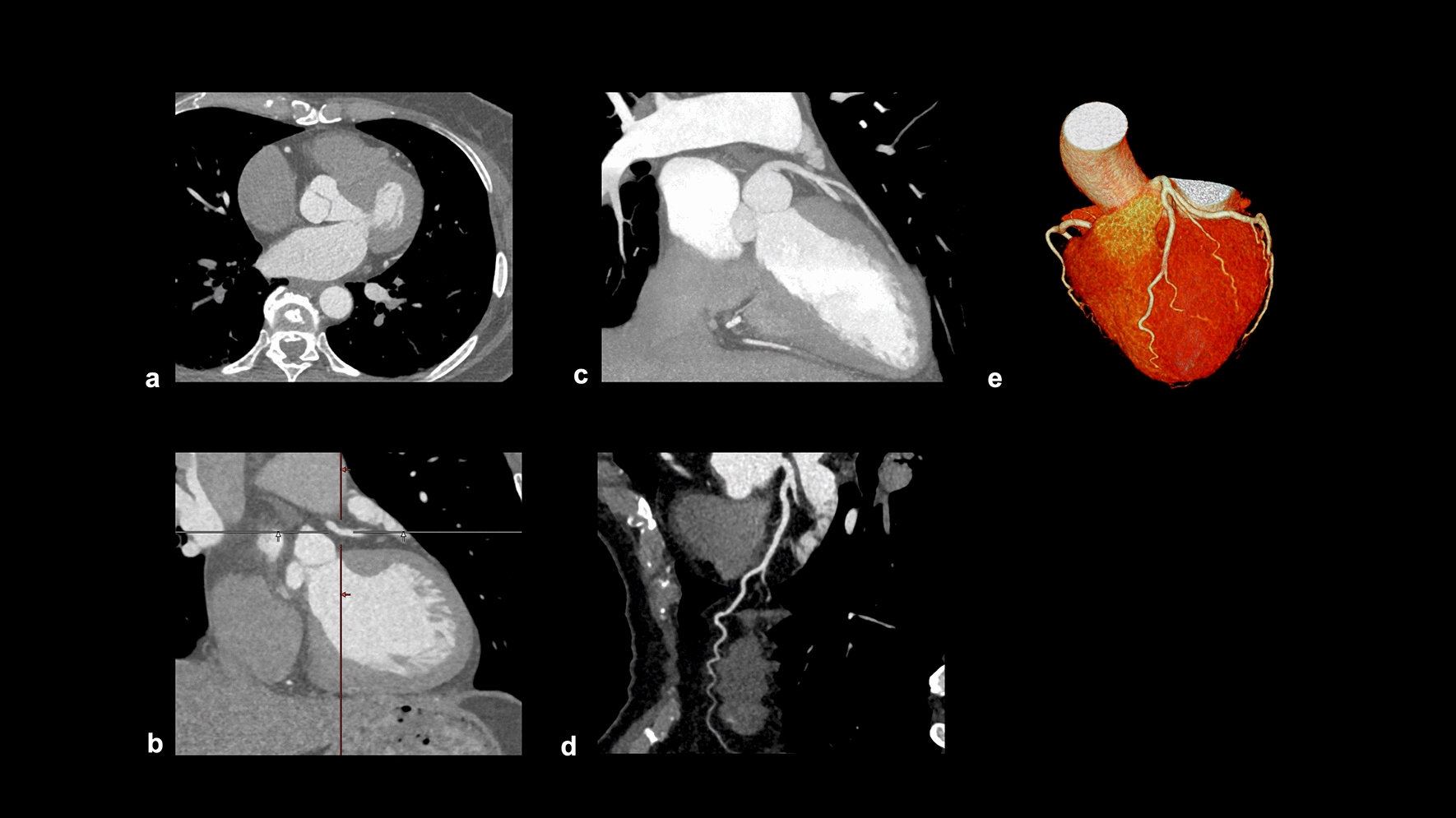 Coronary computed tomography angiography for clinical practice