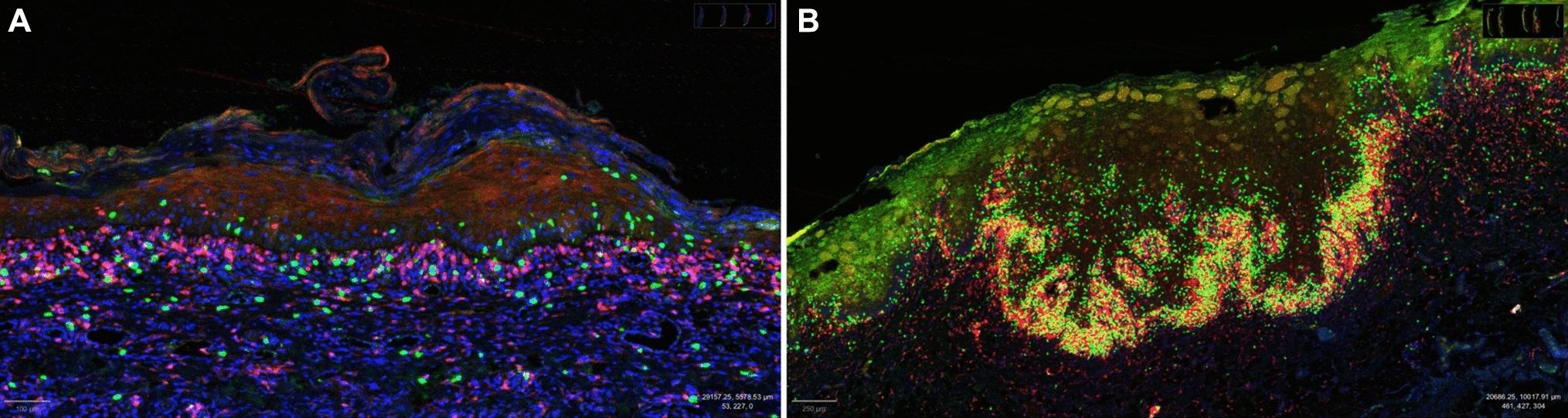 Immunophenotypic and Gene Expression Analyses of the Inflammatory Microenvironment in High-Grade Oral Epithelial Dysplasia and Oral Lichen Planus