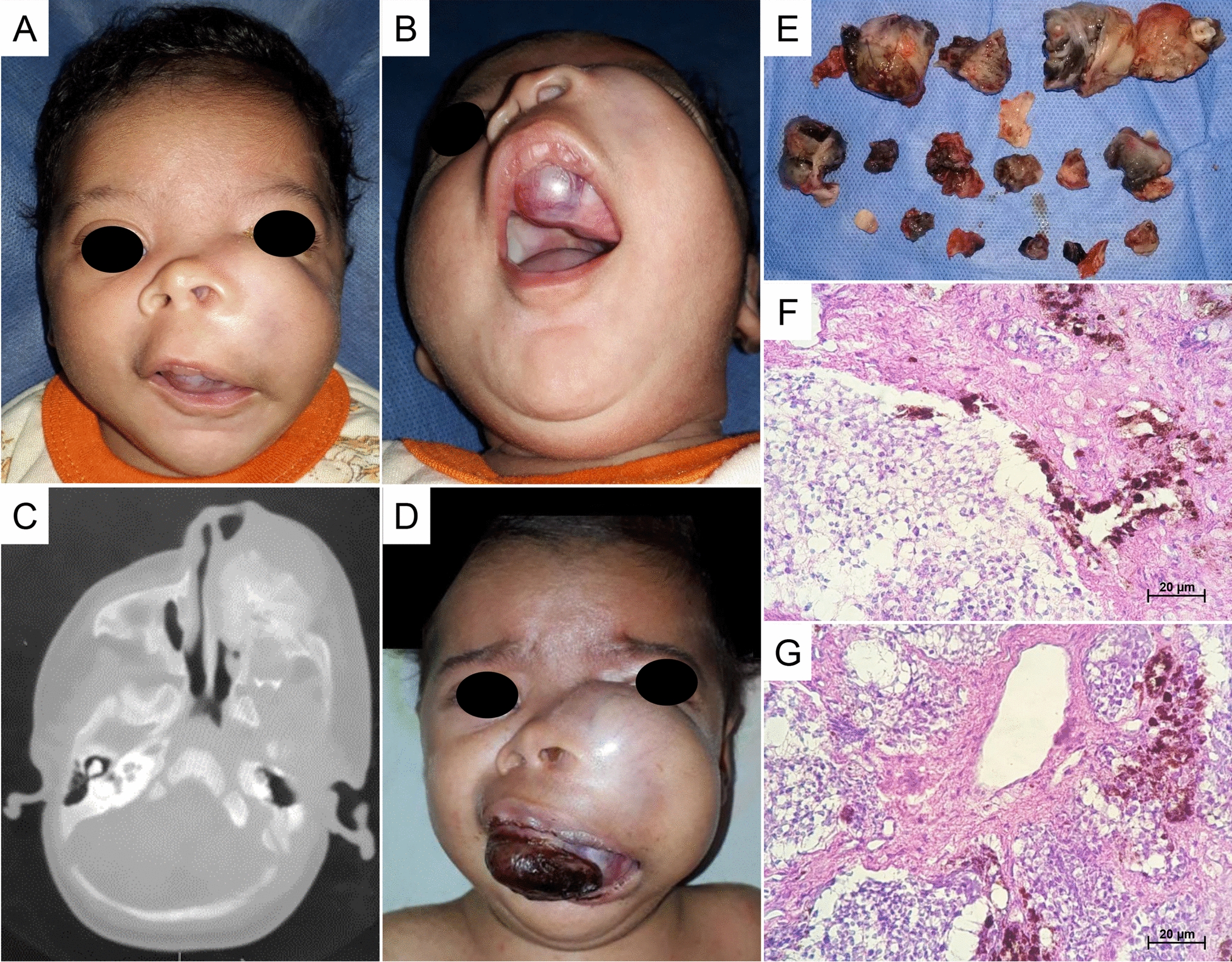 Melanotic Neuroectodermal Tumor of Infancy: A Case Image