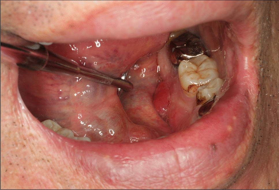 Primary Oral Mixed Neuroendocrine–Non-neuroendocrine Neoplasm (MiNEN): A Rare Case Report and Review of the Literature