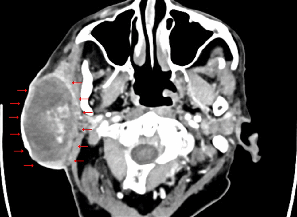Pleomorphic Adenoma with a Novel Gene Rearrangement—LINC01606::PLAG1