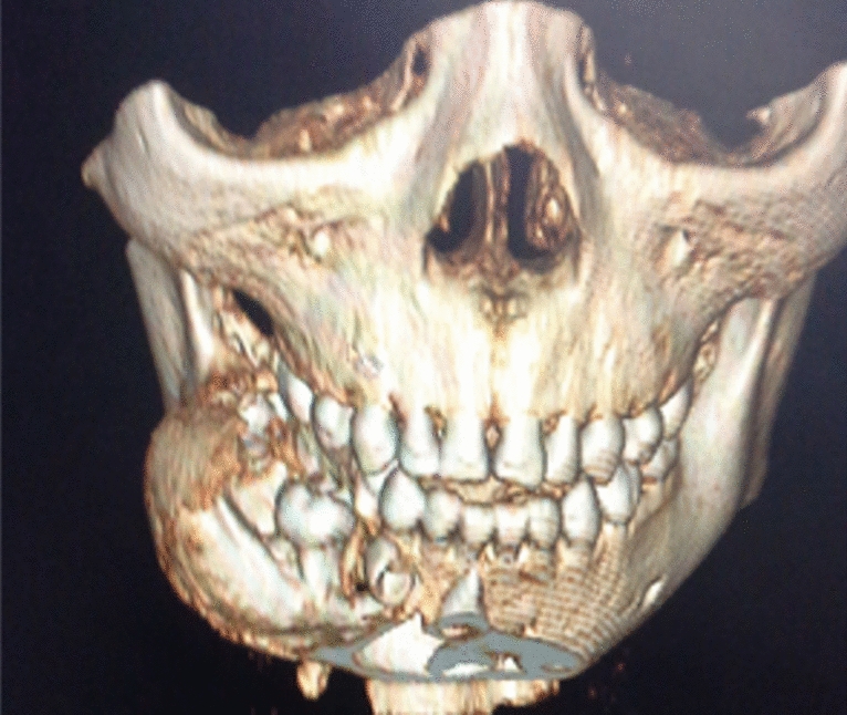 Odontoameloblastoma: A Distinct Entity?