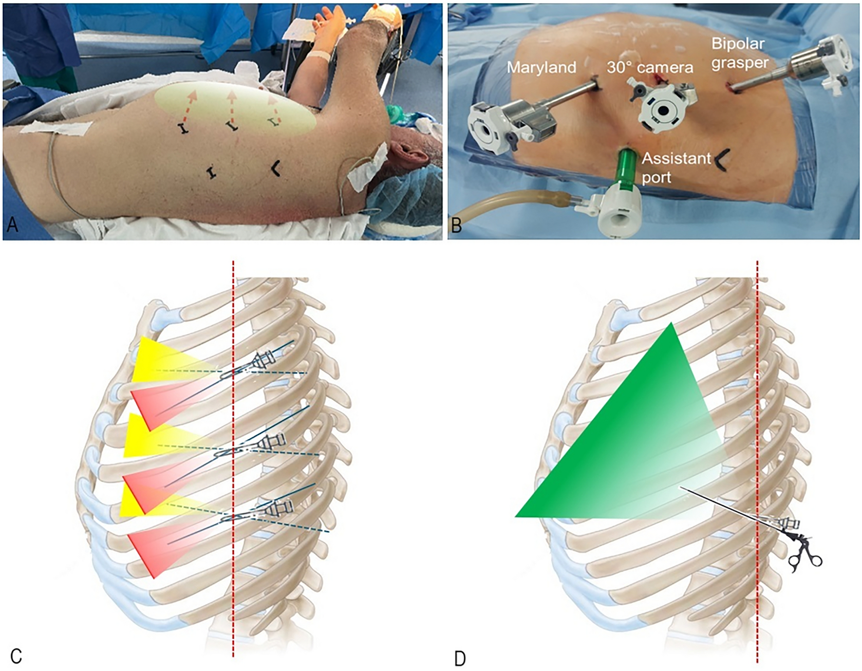The modified Lyon’s position: an alternative approach to robotic thymectomy
