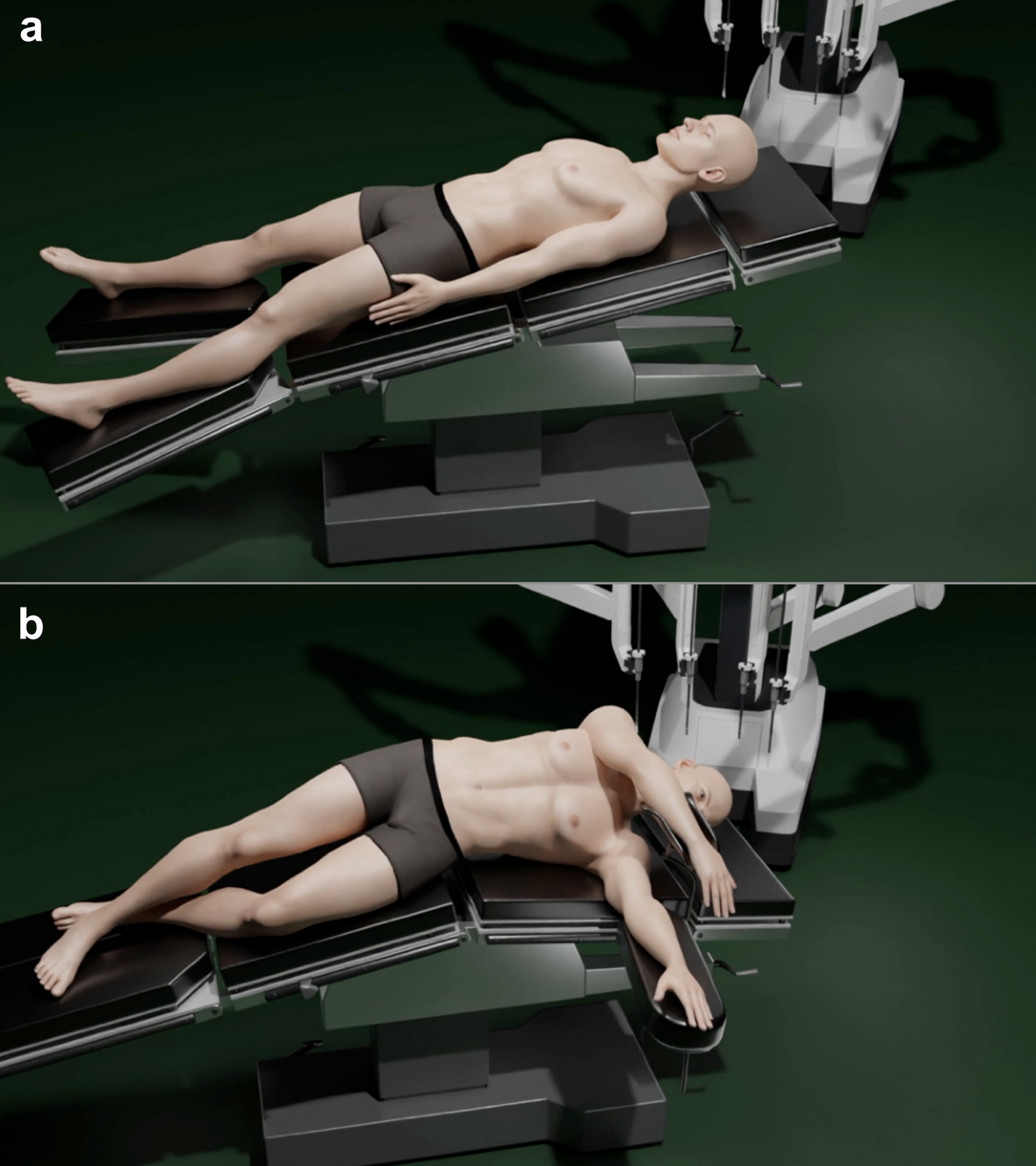 Microfracture-coagulation for the real robotic liver parenchymal transection
