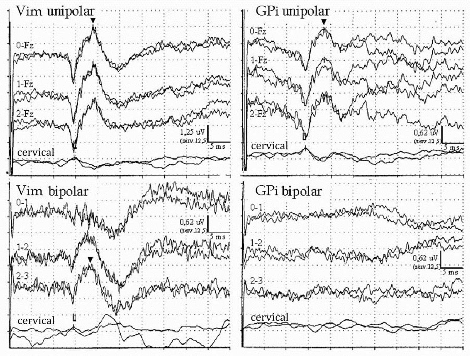 Somatosensory evoked potentials recorded from DBS electrodes: the origin of subcortical N18