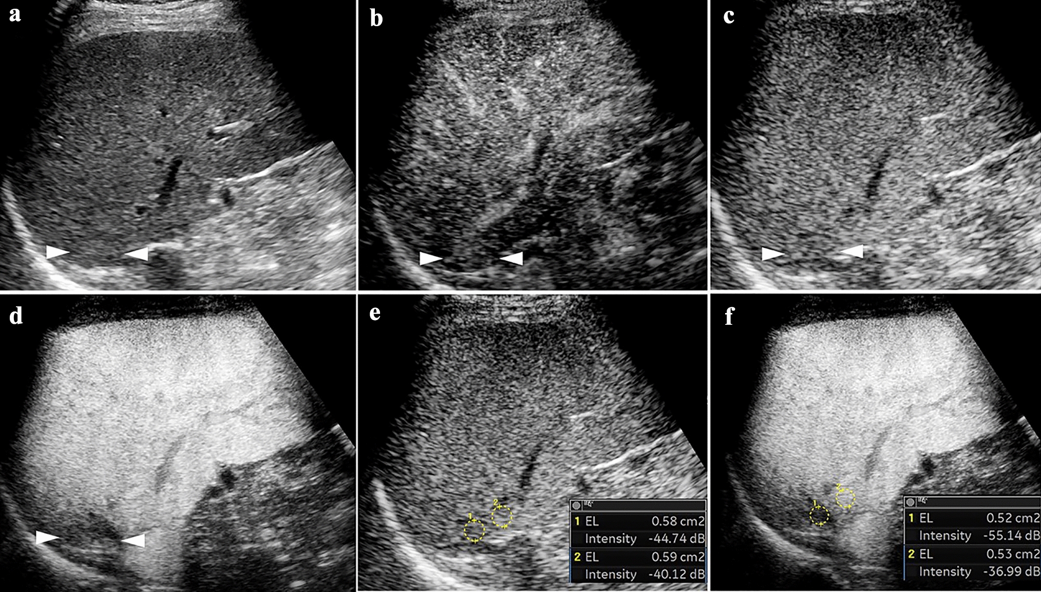 Enhancing deep-seated hepatocellular carcinoma detection: assessing the added value of high mechanical index setting in sonazoid-based contrast-enhanced ultrasound during post-vascular phase