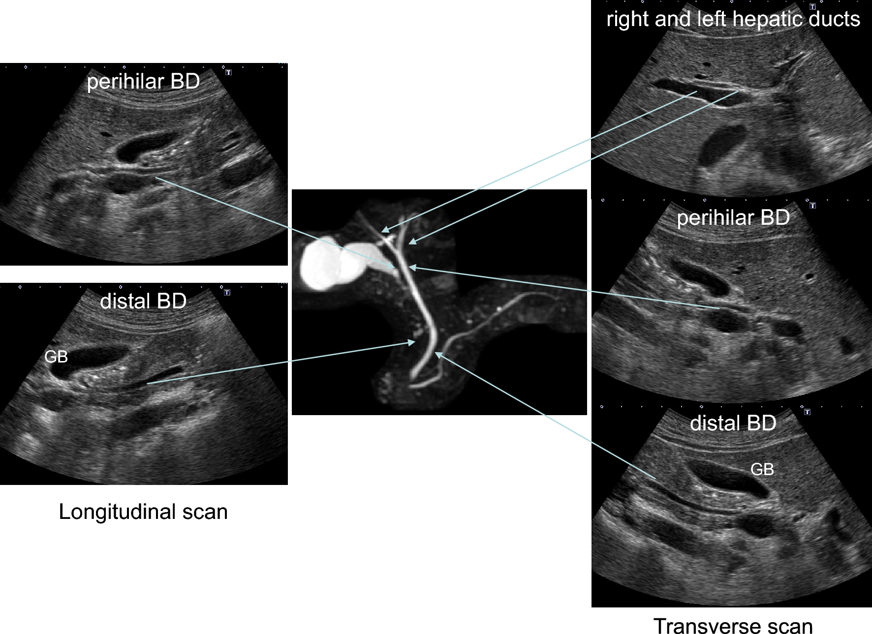 Advanced ultrasound diagnosis of extrahepatic bile duct lesions
