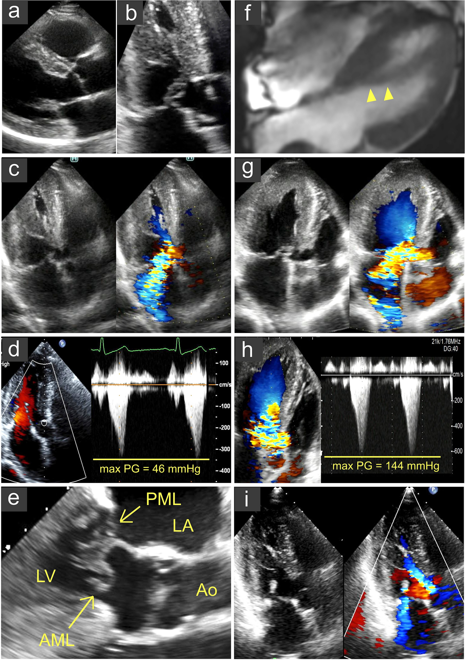 Severe mitral regurgitation in non-hypertrophic cardiomyopathy caused by systolic anterior motion of the mitral valve