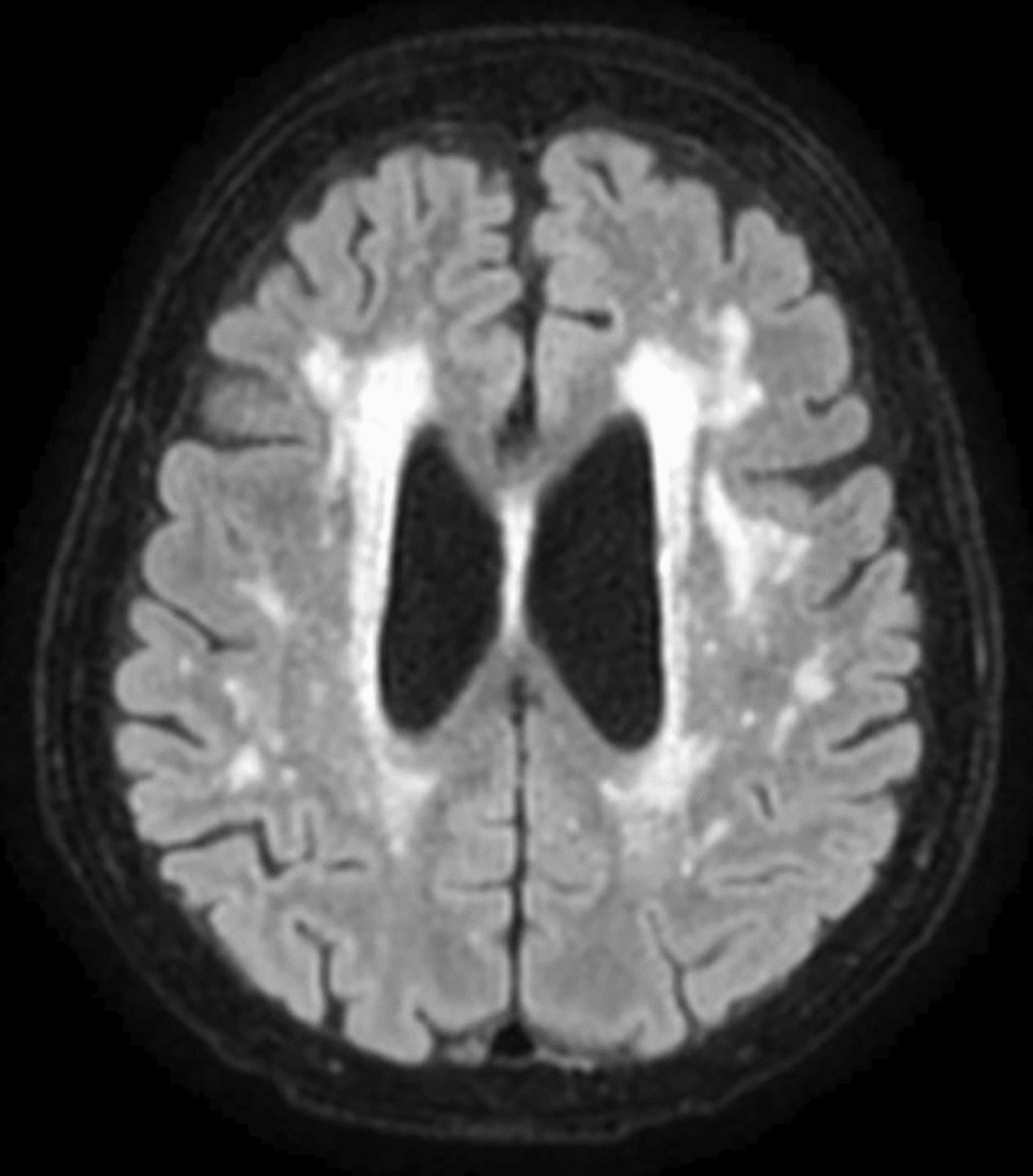 Ceftriaxone encephalopathy in a very elderly dialysis patient
