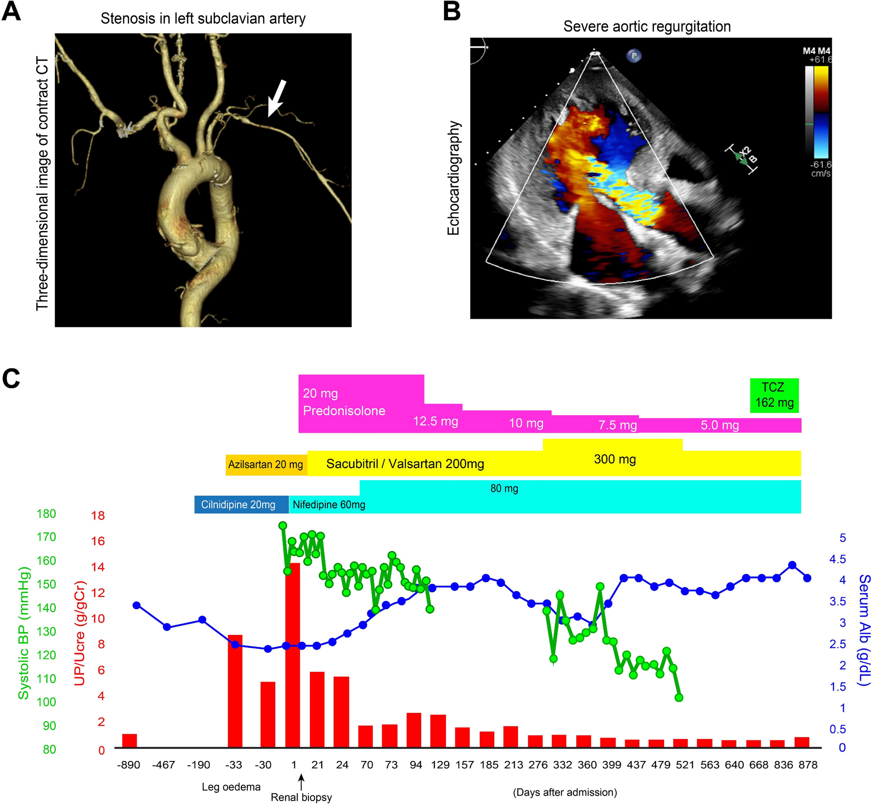Takayasu arteritis-associated refractory hypertension induces nephrotic syndrome through glomerular microangiopathy