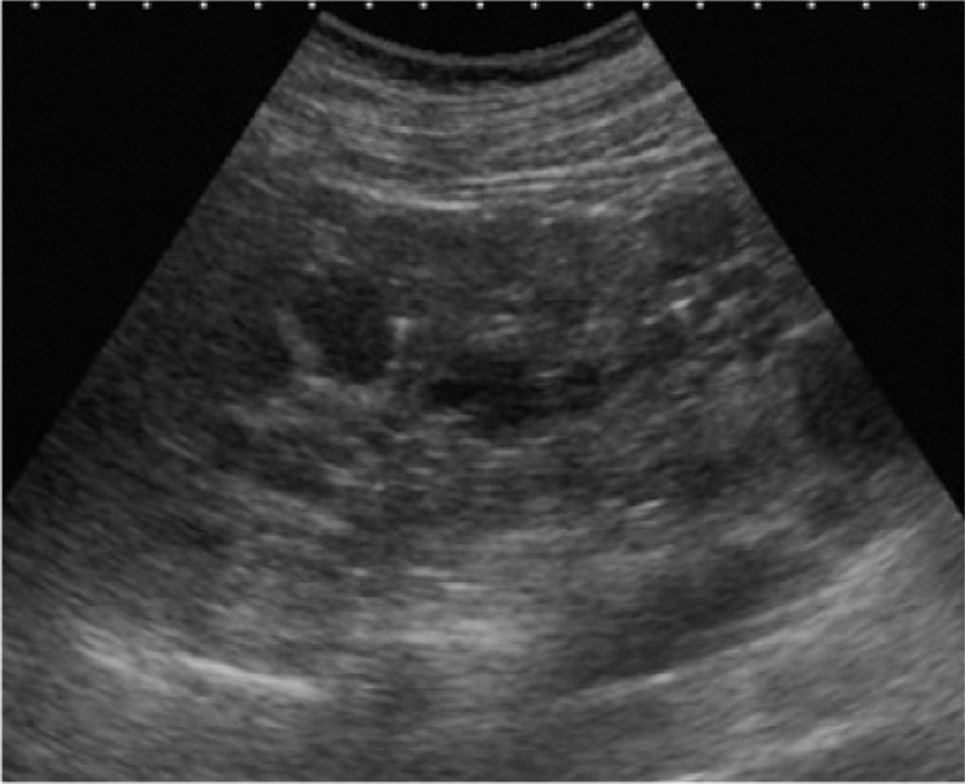 Secondary infertility due to necrospermia in men with autosomal-dominant polycystic kidney disease: a report of two cases