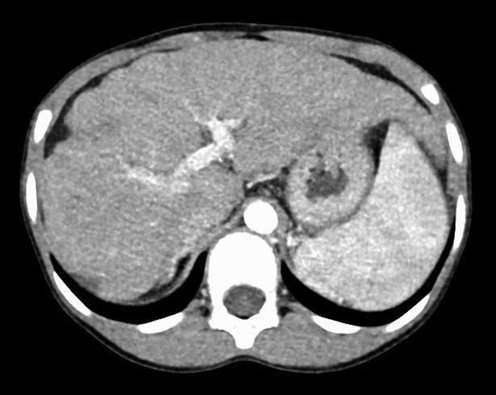 Nephronophthisis 13 caused by WDR19 variants with pancytopenia: case report