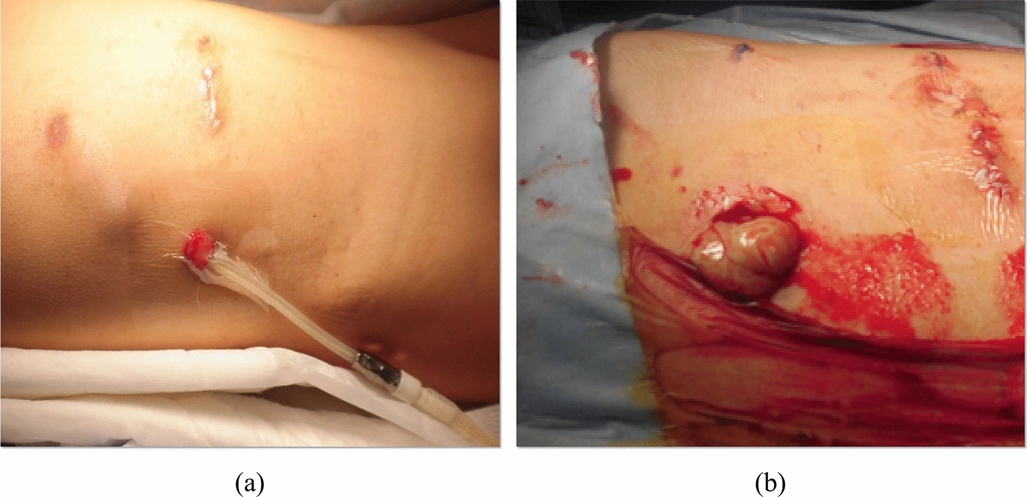 Peritoneal dialysis-associated infection caused by Mycobacterium abscessus in a pediatric patient on continuous peritoneal dialysis without switching to hemodialysis