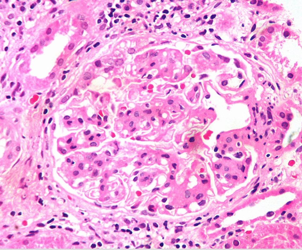A case report and literature review of IgA nephropathy presenting as nephrotic syndrome in polycythemia vera