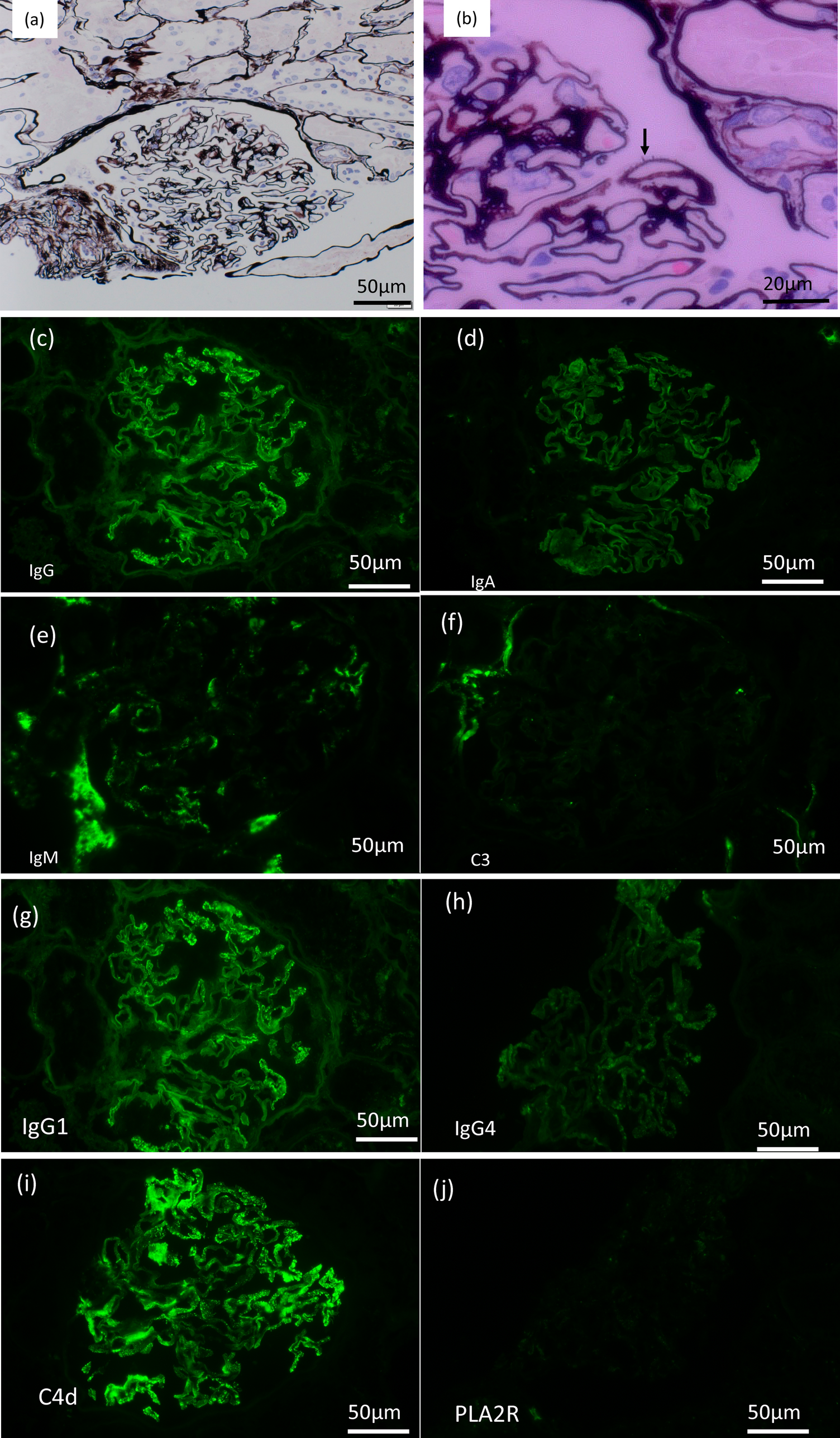 De novo posttransplant membranous nephropathy after COVID-19 vaccination 9 years after renal transplantation in a patient with polycystic kidney disease