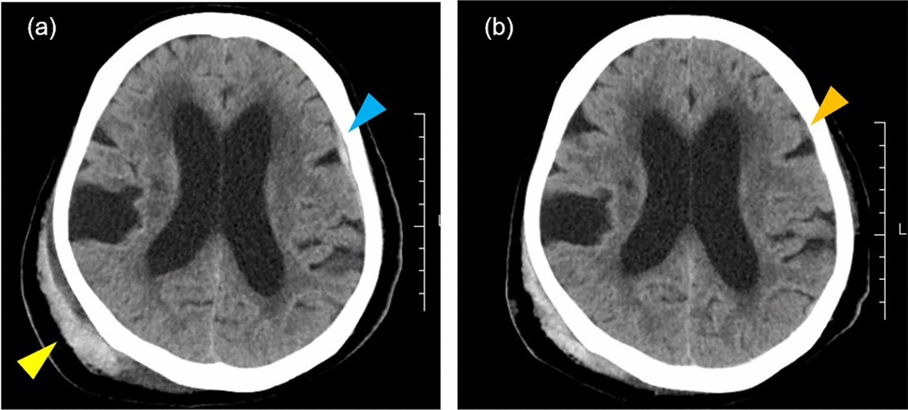 Primary adrenal insufficiency developed 22 years after the diagnosis of light and heavy chain deposition disease: a case report
