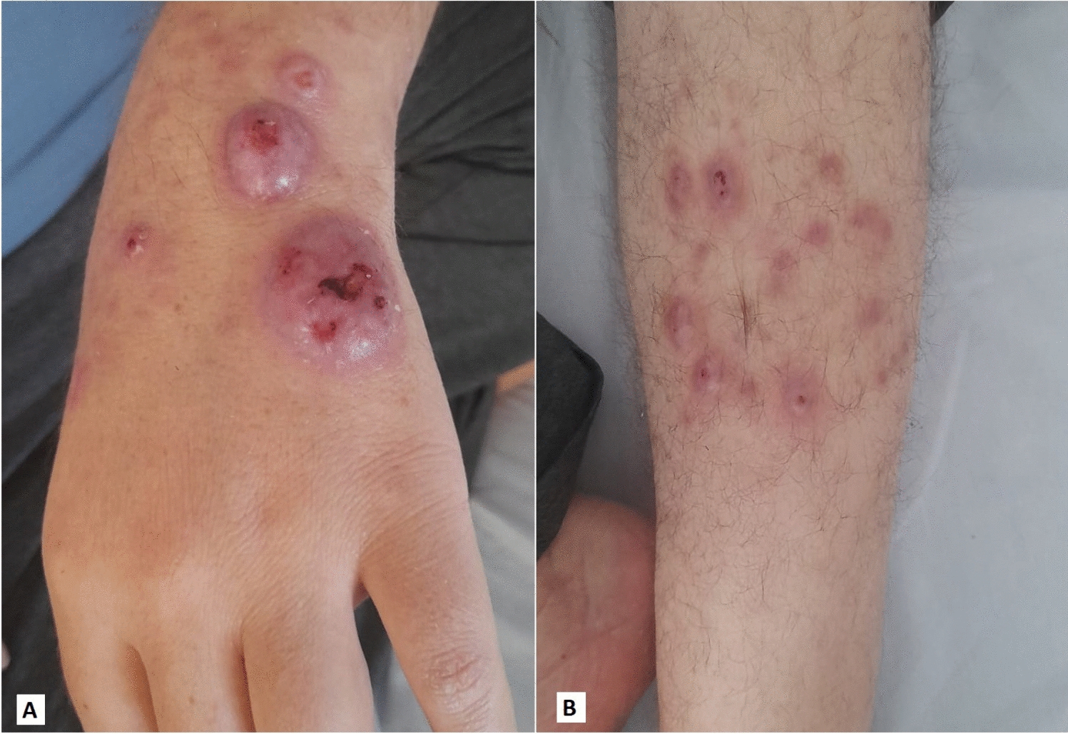 Widespread form of Majocchi’s granuloma in a kidney transplant recipient