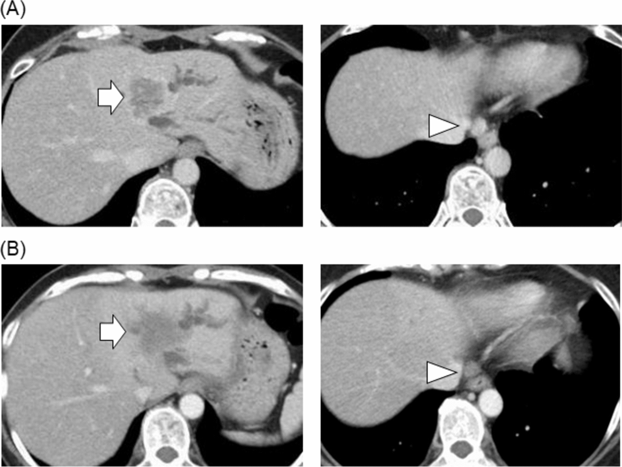 Cognitive and ataxic adverse events following entrectinib treatment in NTRK1 fusion gene-positive intrahepatic cholangiocarcinoma: a case report