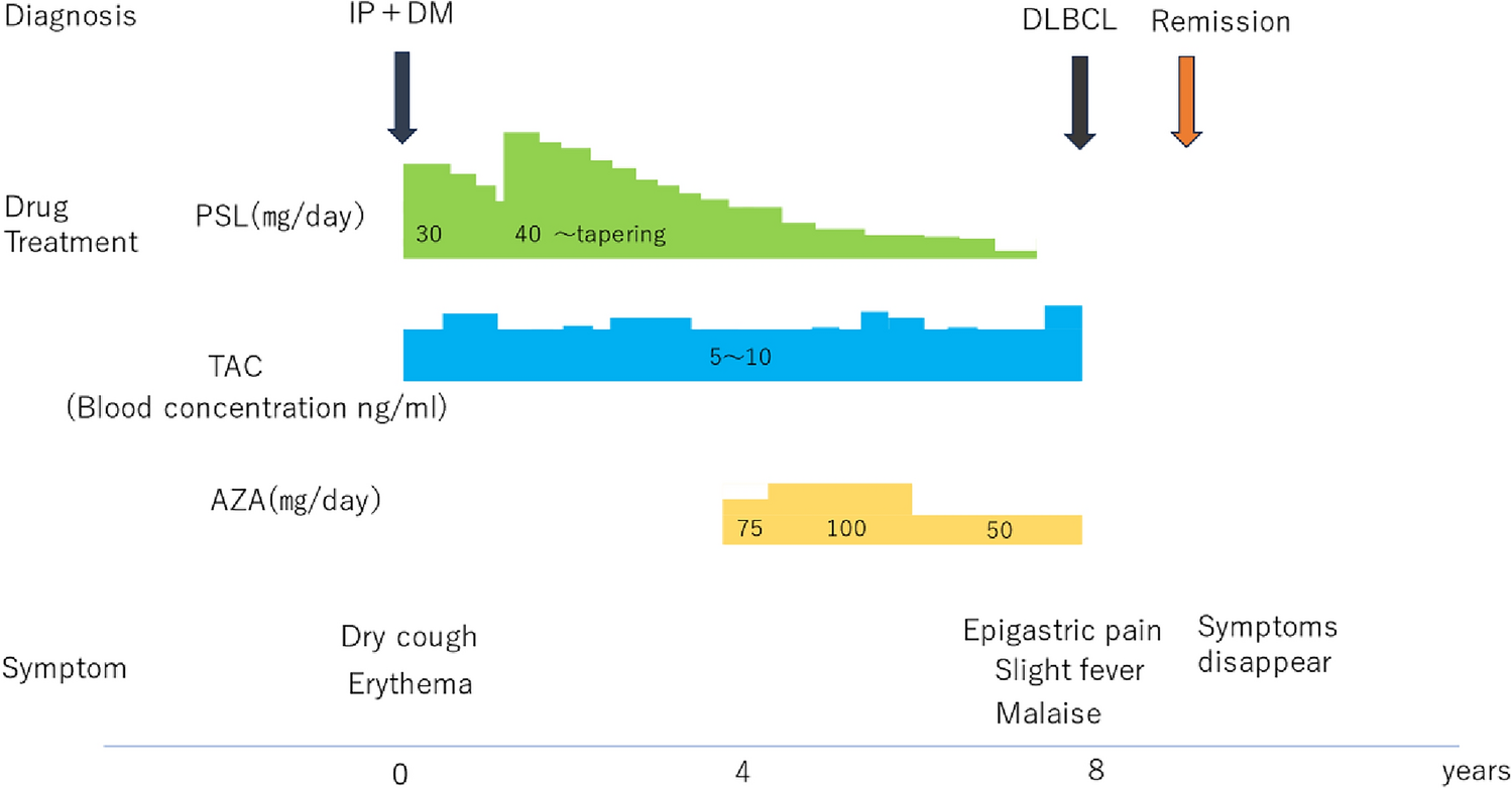 A case of gastric/duodenal diffuse large B cell lymphoma observed during the administration of tacrolimus/azathioprine for dermatomyositis