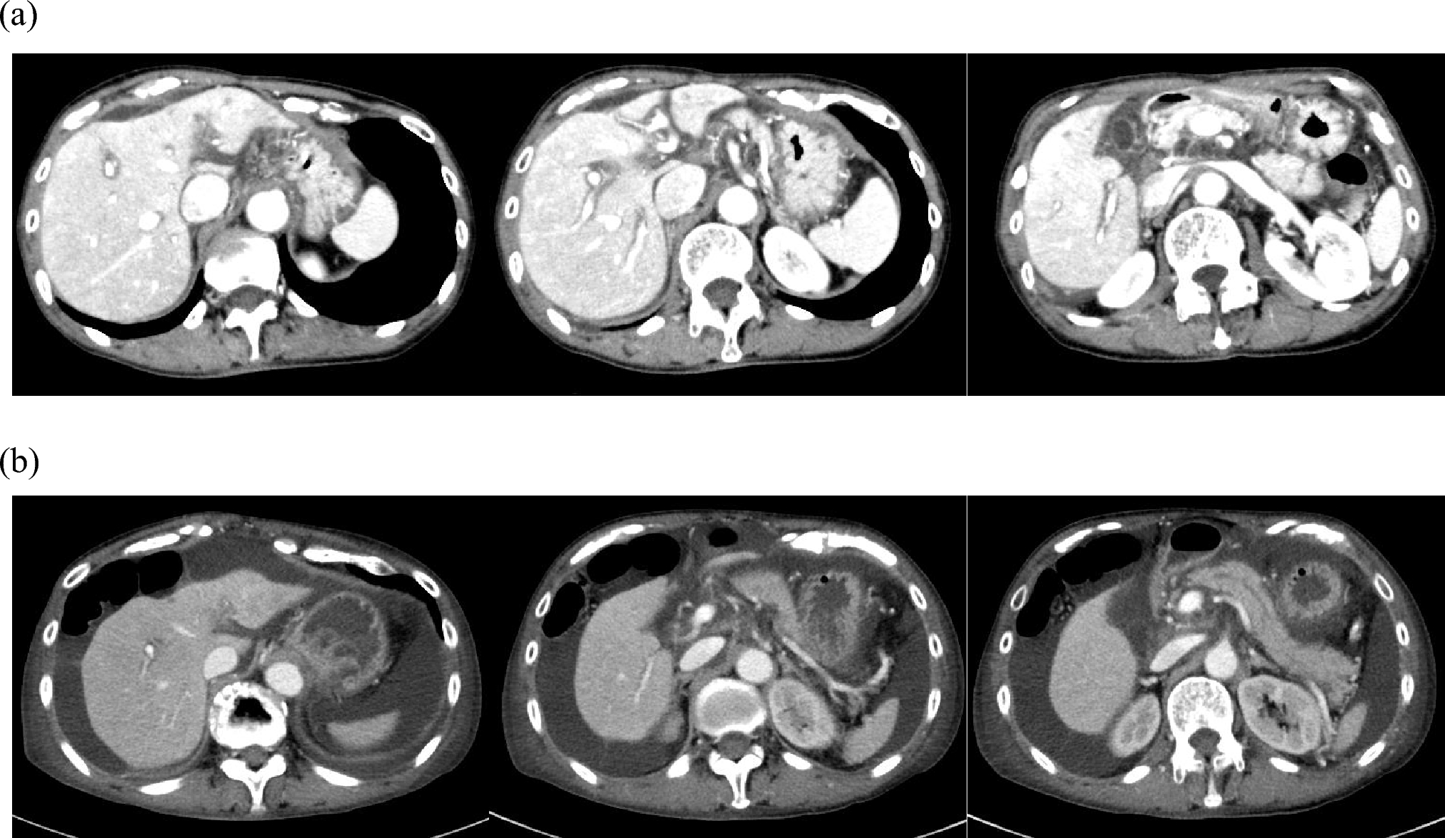 Comprehensive genome analysis of hepatitis B virus using nanopore sequencing technology in patients with previously resolved infection and spontaneous reactivation without drug exposure