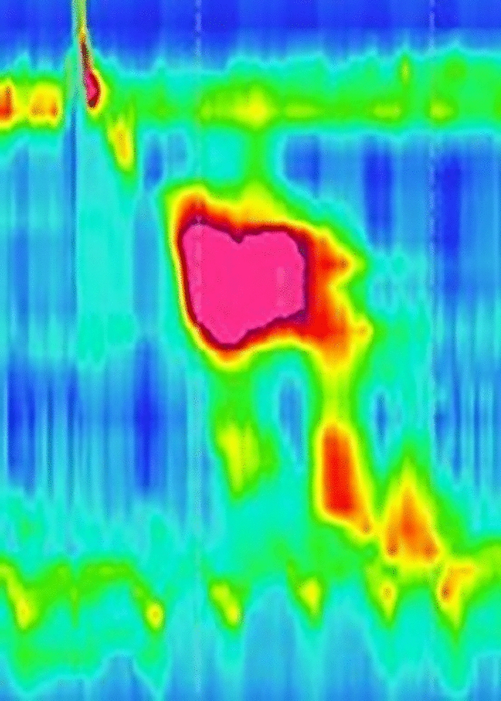 Endoscopic ultrasound navigated application of botulinum toxin in severe esophageal motility disorder