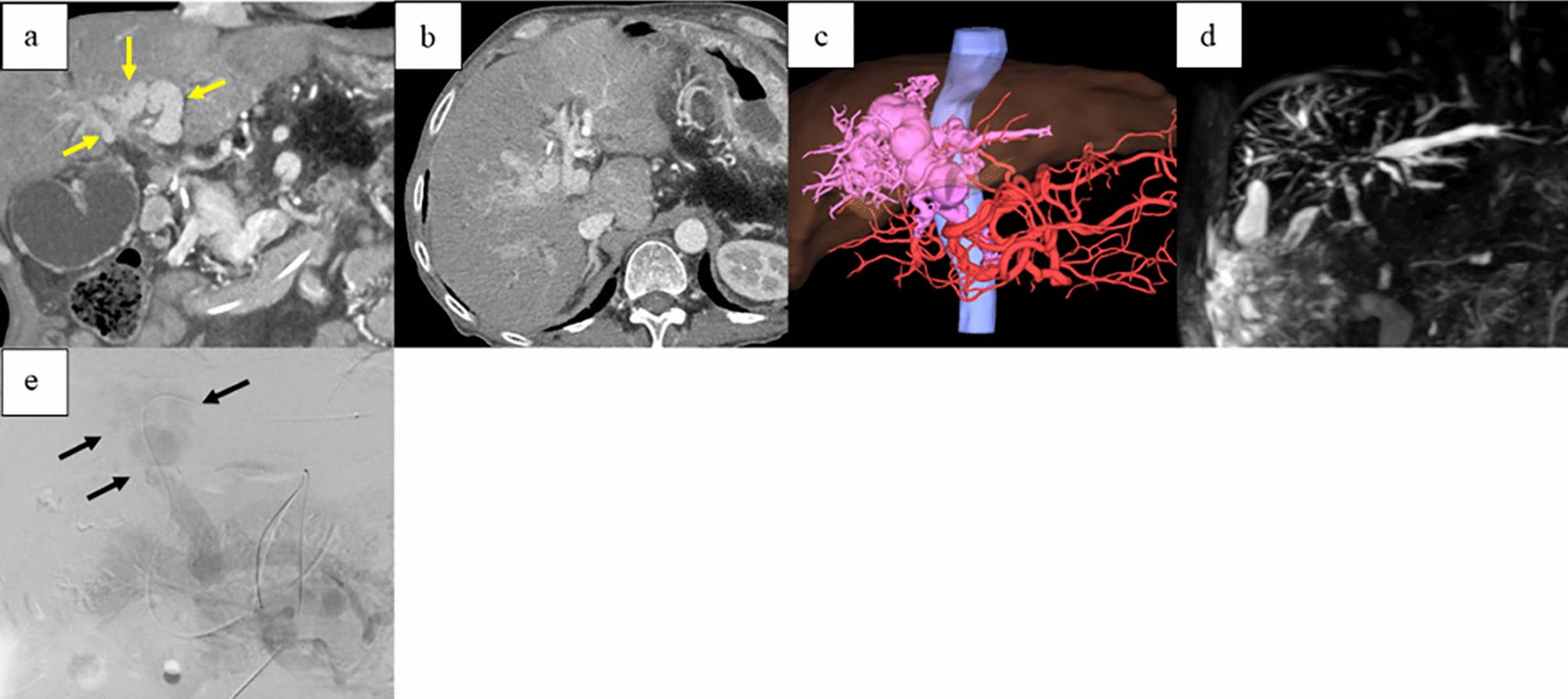 Portal cavernoma cholangiopathy treated with living donor liver transplantation: a case report and review of the literature
