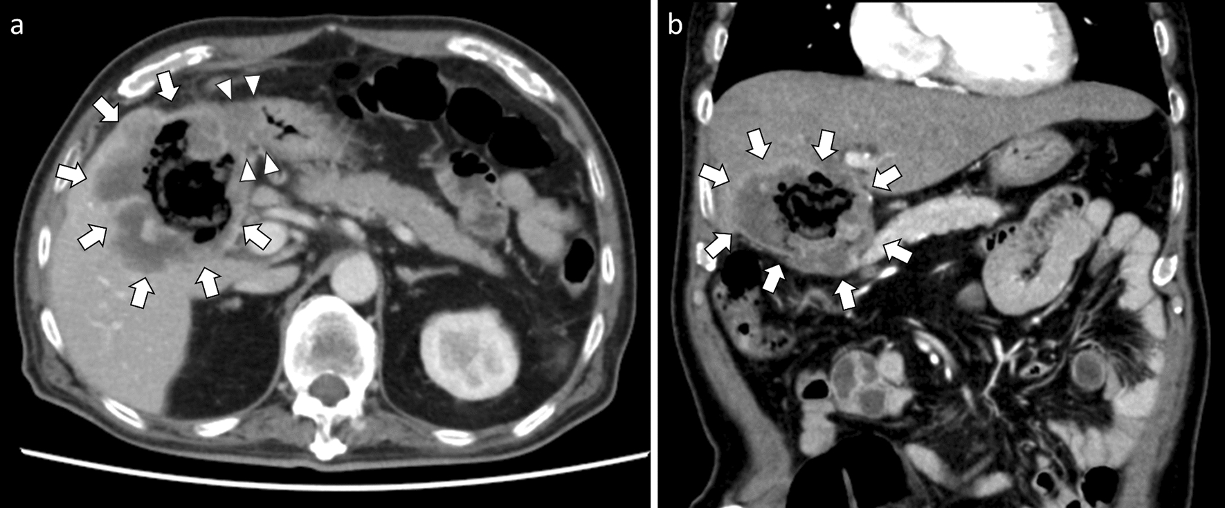 Diffuse large B-cell lymphoma of the gallbladder with hepatoduodenal invasion exhibiting a necrotic tendency