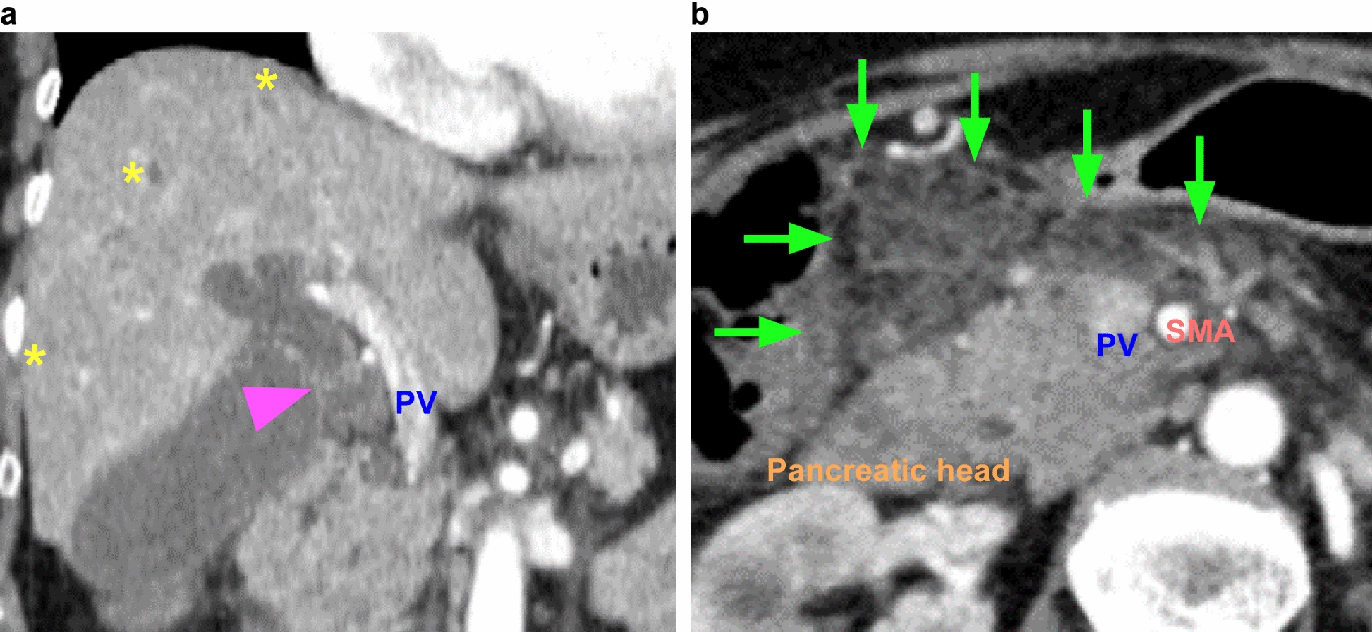 Rapid deterioration of steatotic liver disease due to portal vein stenosis after pancreaticoduodenectomy