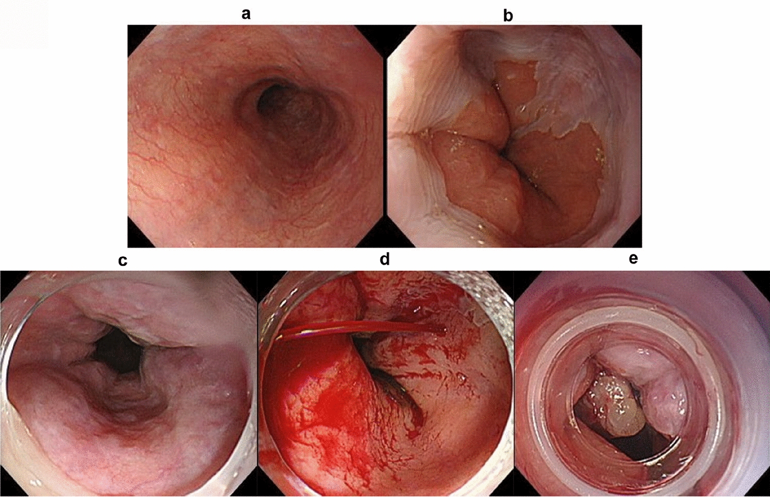 Variceal bleeding following treatment with atezolizumab plus bevacizumab in two patients with unresectable hepatocellular carcinoma