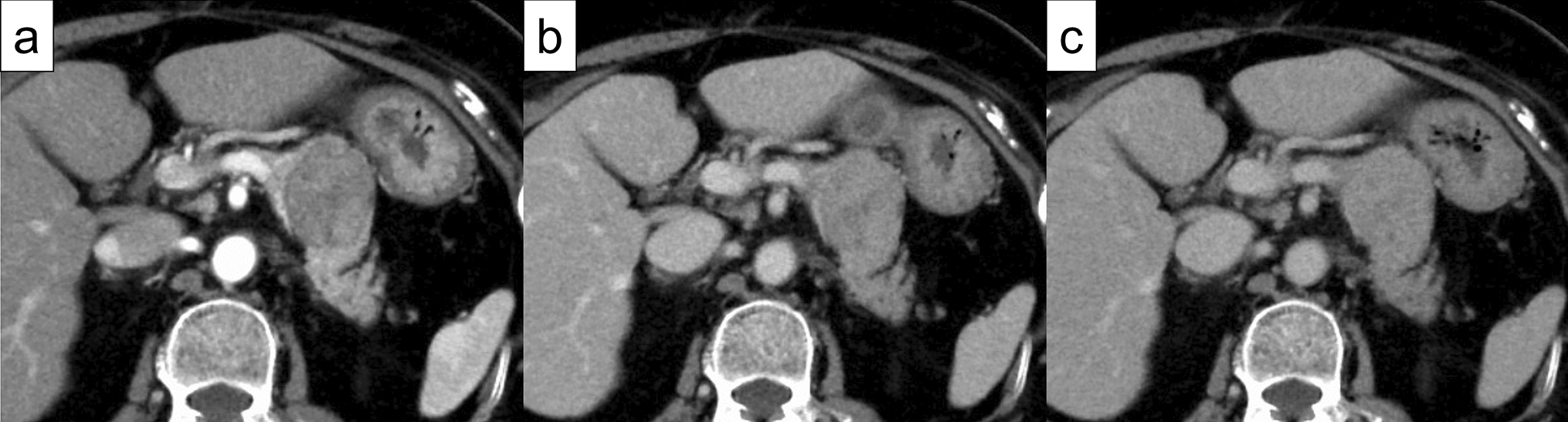 Endoscopic ultrasound-guided fine-needle biopsy diagnosing pancreatic metastasis seven years after renal leiomyosarcoma resection: a case report