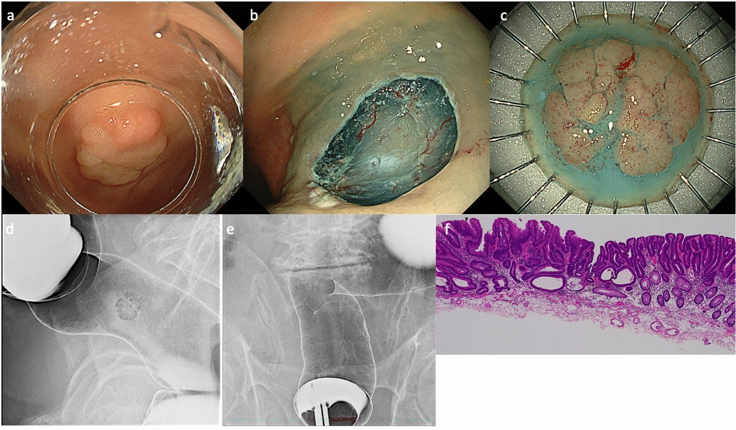 A case of colon cancer implanted on endoscopic resection ulcer certified by cancer genomic testing