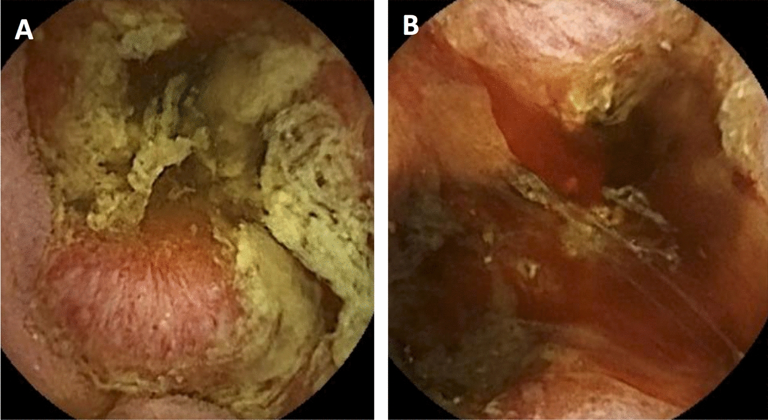 A small bowel adenocarcinoma harboring a DDR2 mutation in a celiac patient