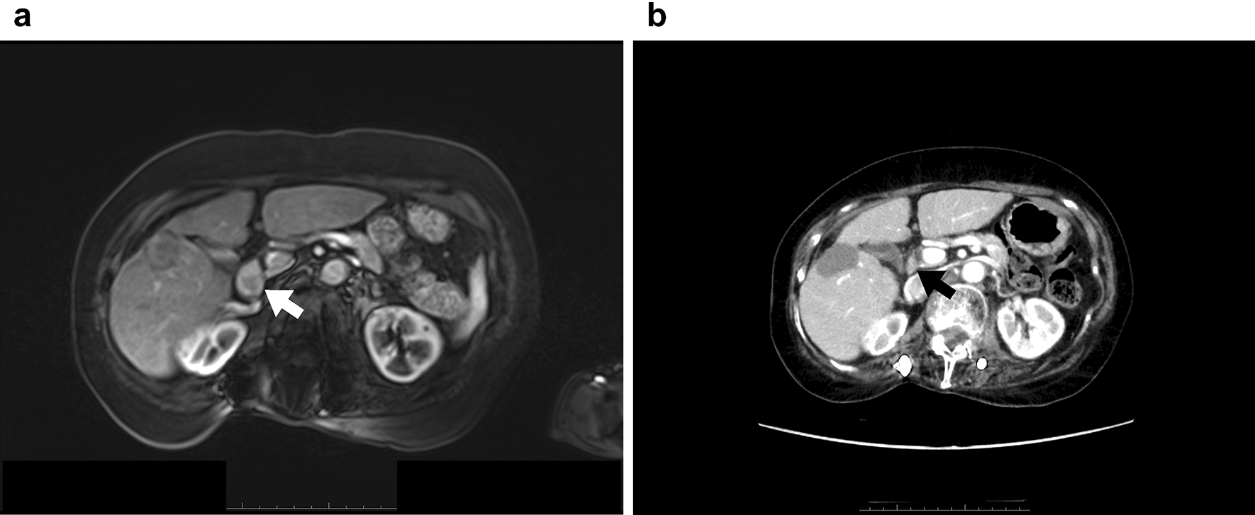 Successful radical surgery for lymph node metastasis in a patient with hepatocellular carcinoma following atezolizumab plus bevacizumab combination therapy: a case report and literature review