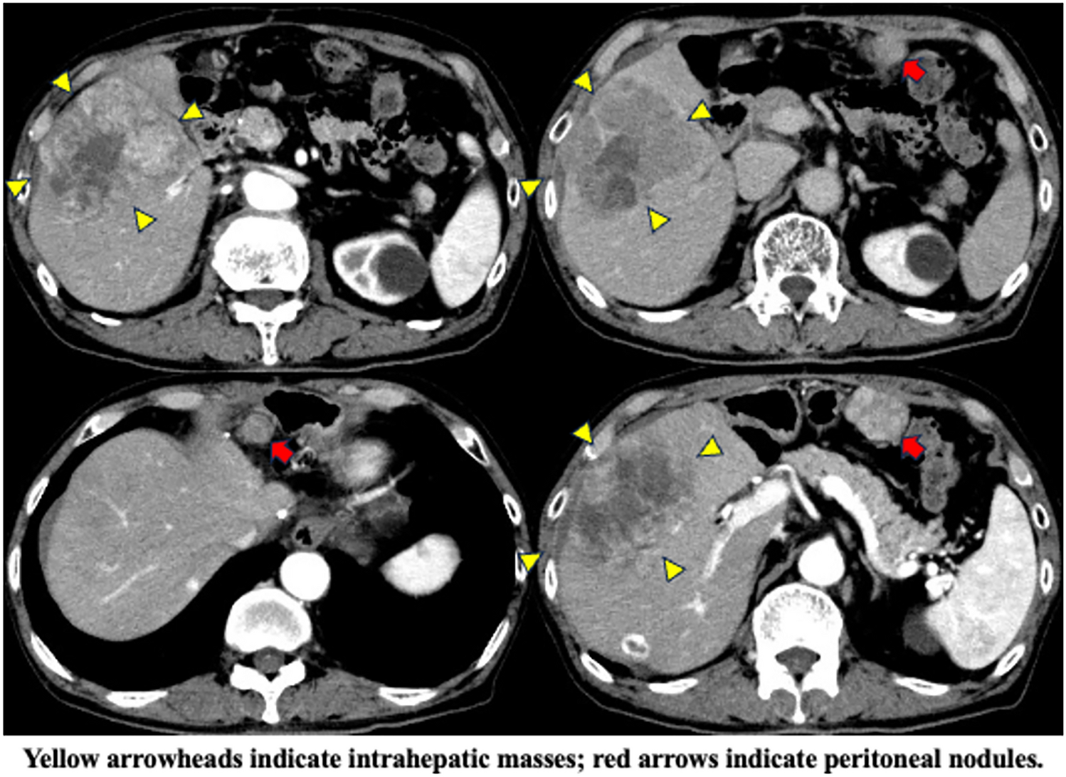 A case of complete remission by cabozantinib as an end-line treatment for advanced hepatocellular carcinoma