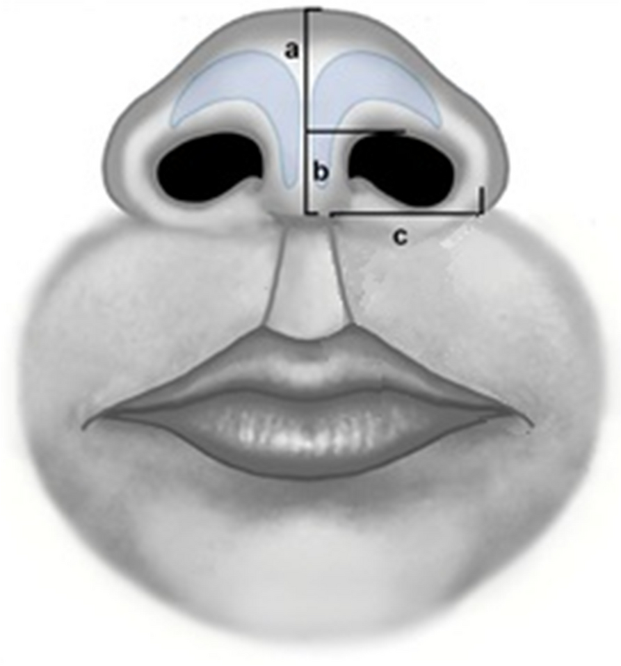 Egyptian patients with cleft lip: our experience with primary rhinoplasty