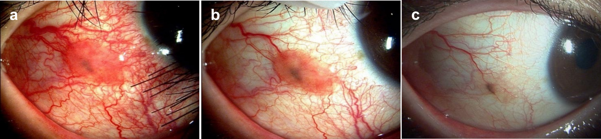 Clinical and pathologic characteristics of inflamed juvenile conjunctival nevus and its treatment with immunosuppressant eye drops