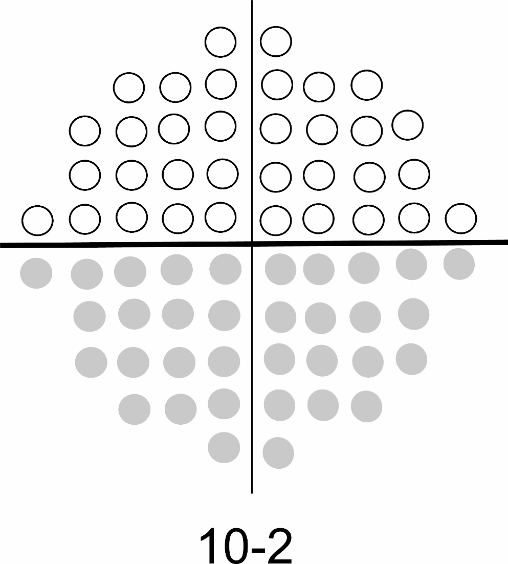 Effects of trabeculectomy on the postoperative central visual field as revealed by refraction values