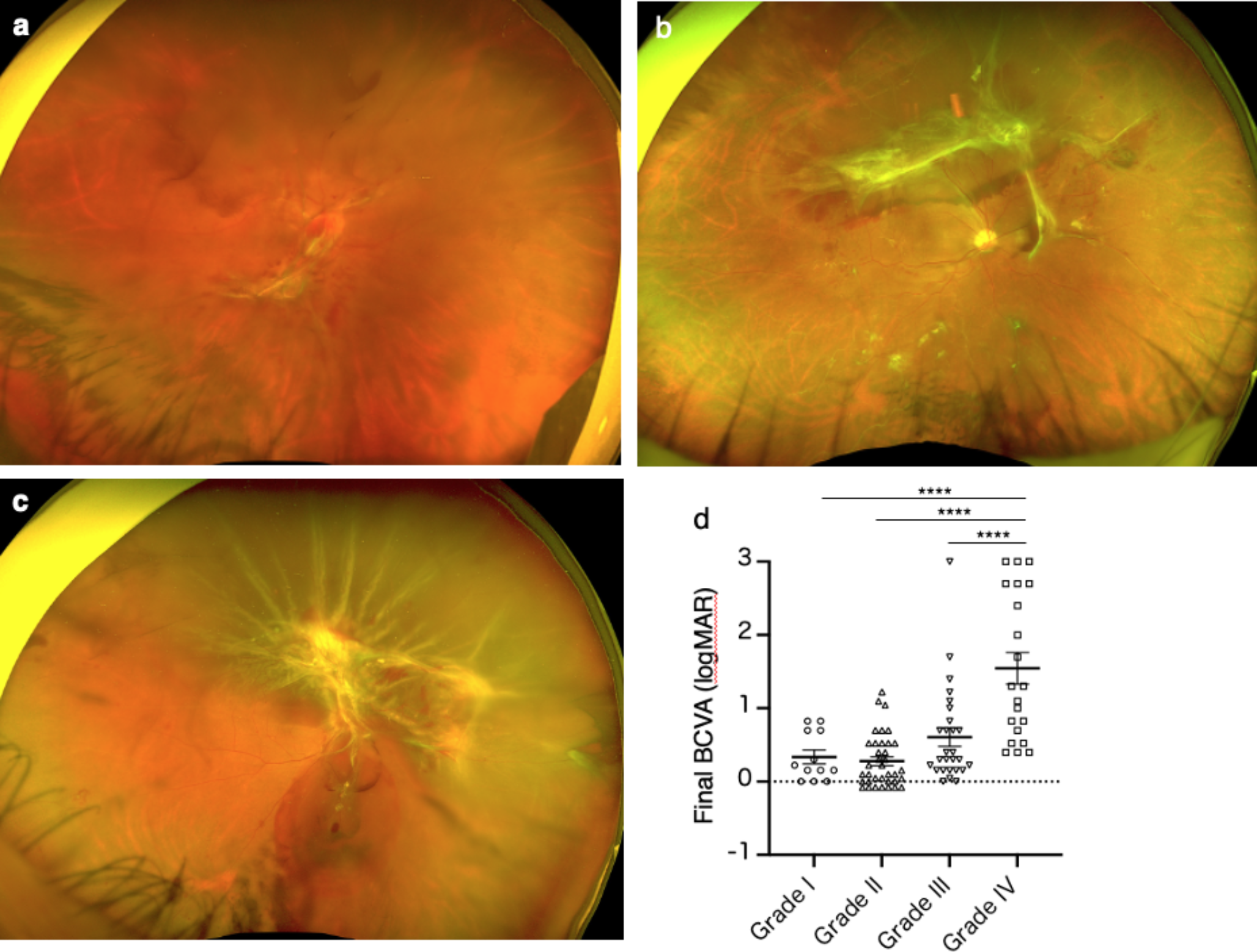 Outcomes, efficacy and risk factors of 27-Gauge vitrectomy for diabetic tractional retinal detachment in Japanese patients