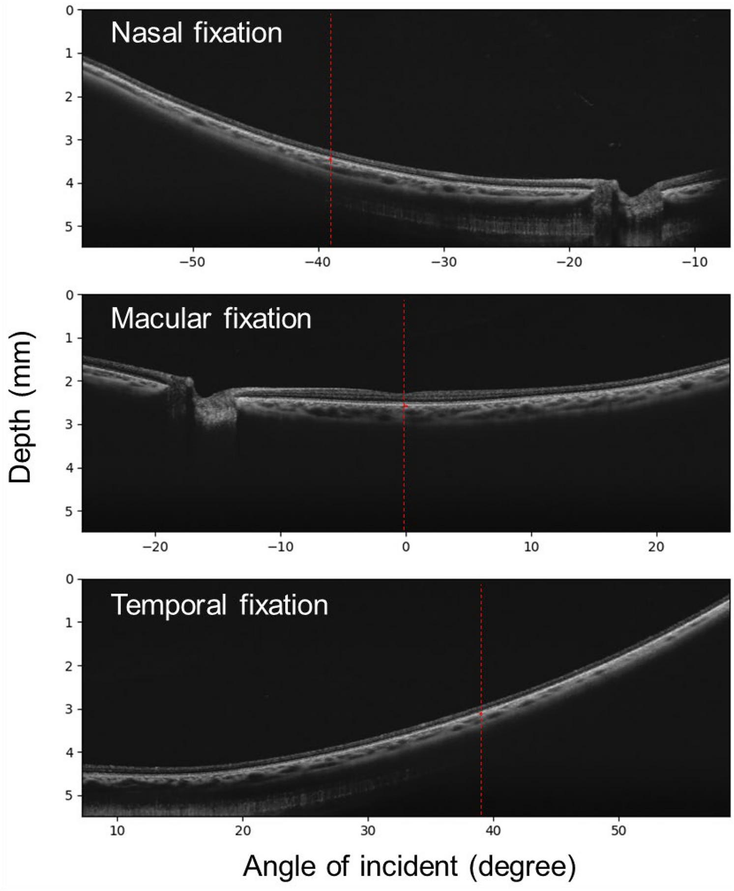 Choroidal thickness in macular, nasal midperiphery, and temporal midperiphery regions and its relationship with axial length and refractive error