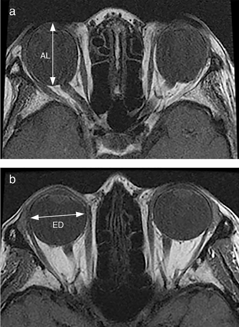 Relationships among eye dimensions in magnetic resonance images by sex, age, and strabismus type in Japanese patients with acquired strabismus and high myopia